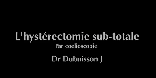 Hysterectomie sub totale Dubuisson J