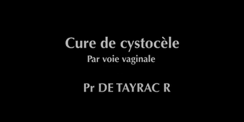 Cure de cystocèle De Teyrac R